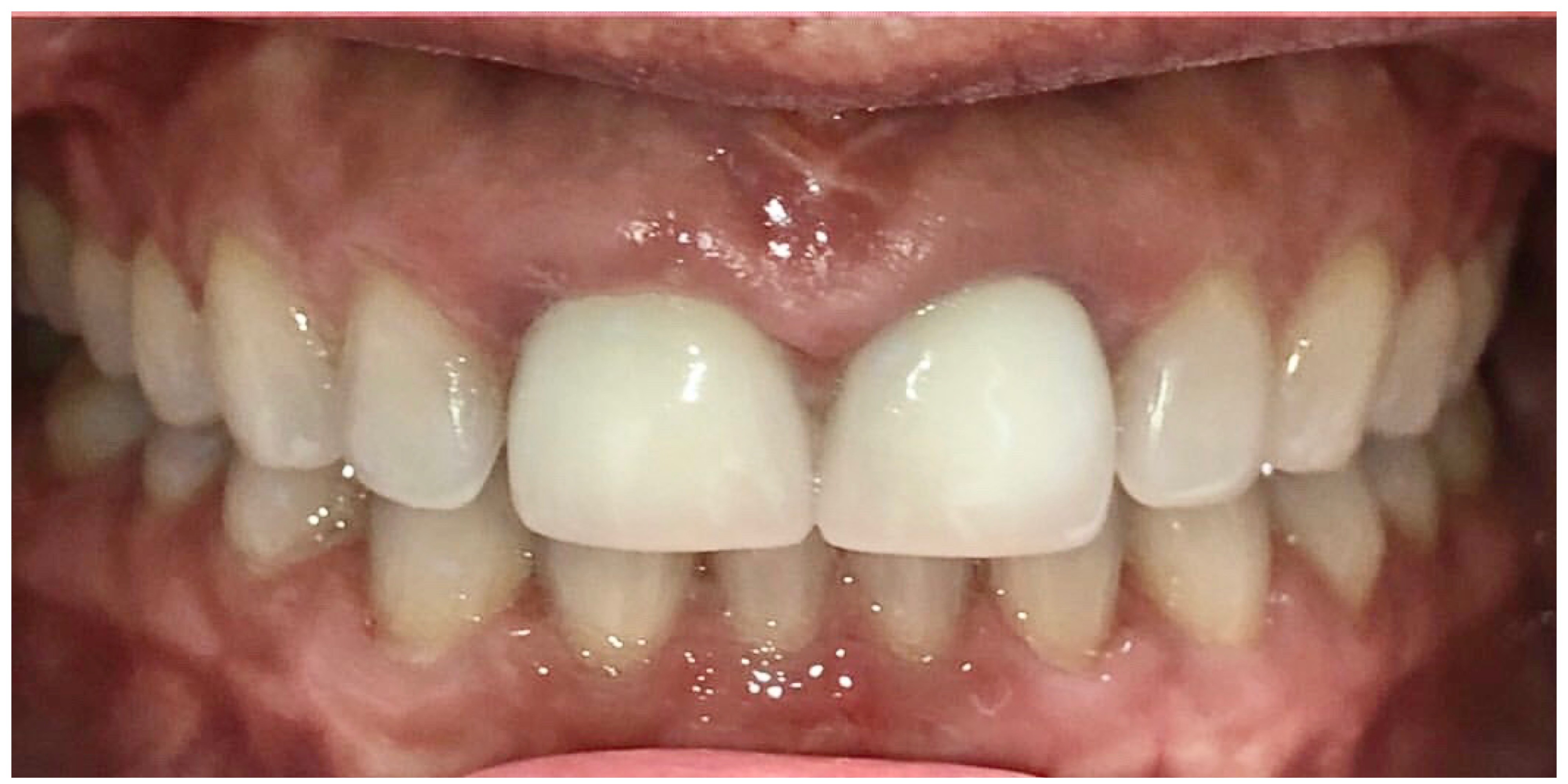 Teeth gap closed after Invisalign